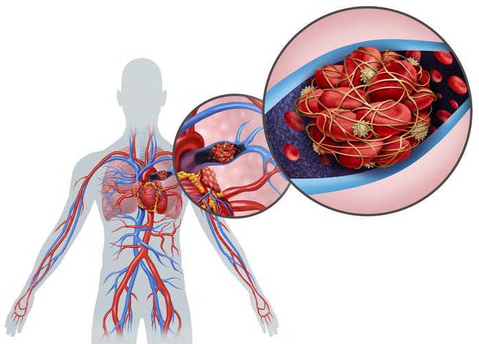 IVC Filter Lawsuits